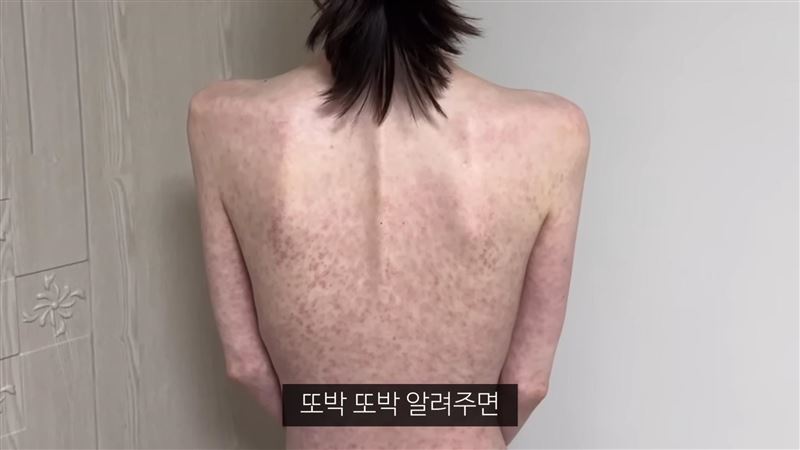 「有病長壽Girl」因為化療暴瘦。（圖／翻攝自Youtube）