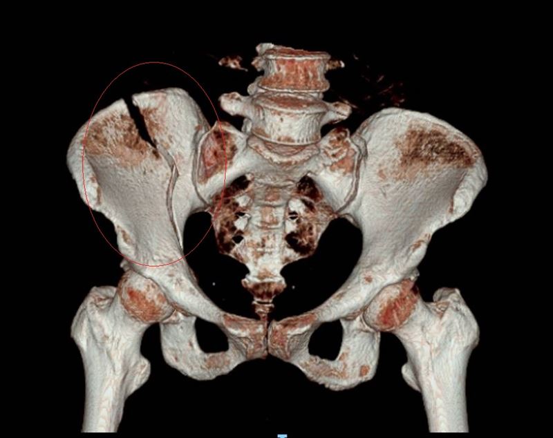 遭休旅車輾壓的陳姓女子，緊急被送醫時，骨盆斷裂。（圖／彰化醫院提供）