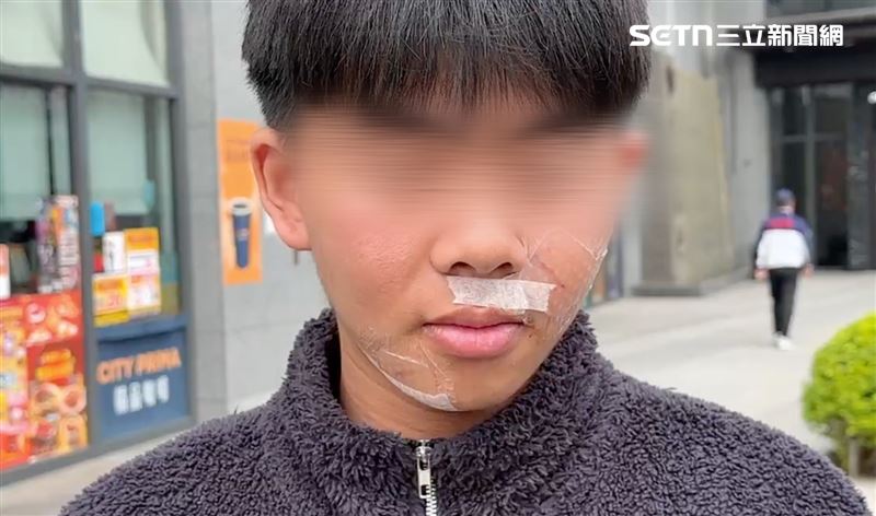 今日男大生出面受訪，臉上的OK蹦佔據五官一半，他坦言受傷後跟家人出去吃飯不敢脫下口罩，「整條法令紋都是疤」。（圖／翻攝畫面）