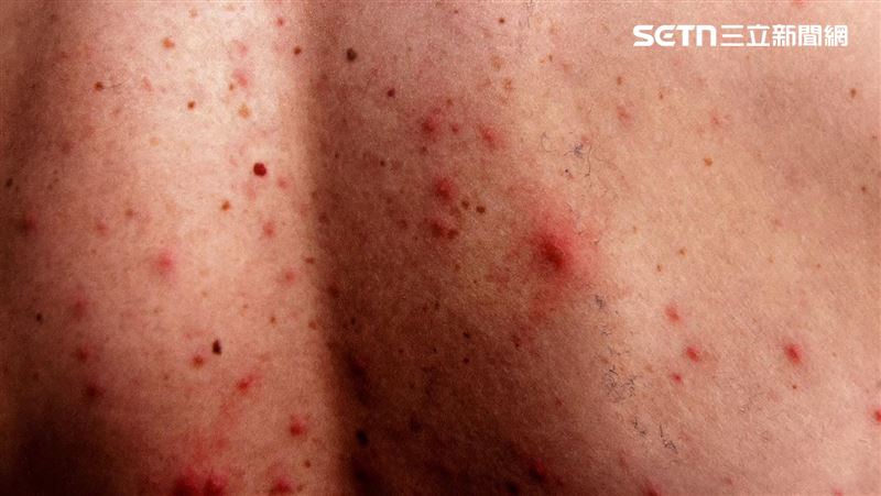 60歲男「全身冒痘」狂抓 醫驚:要洗腎了