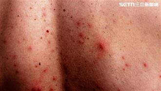 60歲男「全身冒痘」狂抓　醫驚：要洗腎了