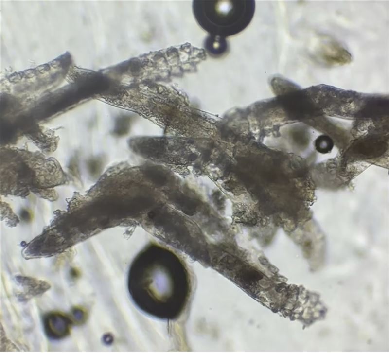 女大生臉藏數百隻蠕形蟎蟲。（圖／王佑鑫醫師授權提供，未經同意請勿轉載）