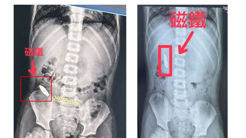 遭逼吞磁鐵!他驚醒哭問「會卡多久」