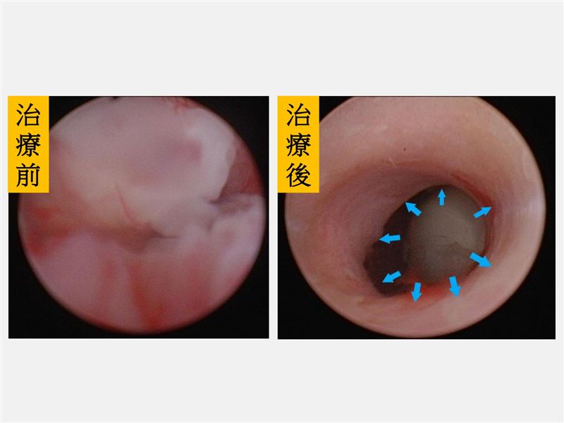 手術前透過內視鏡發現，婦人尿道完全被腫瘤阻塞。(圖／仁愛長庚醫院提供)