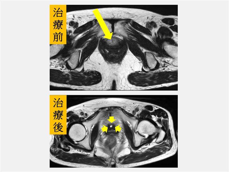 經放療與化療治療後，經核磁共振掃描發現尿道已無腫瘤。(圖／仁愛長庚醫院提供)