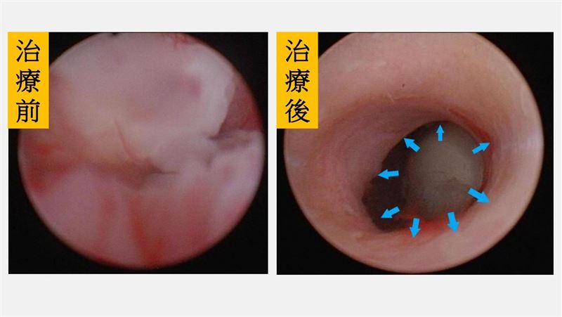 7旬嬤反覆血尿疼痛治不好 竟罹罕癌第3期