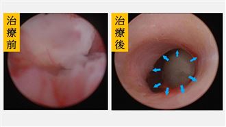 7旬嬤反覆血尿疼痛治不好　竟罹罕癌第3期