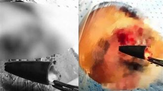 46歲男眼痛　開刀取出2.5cm筆頭