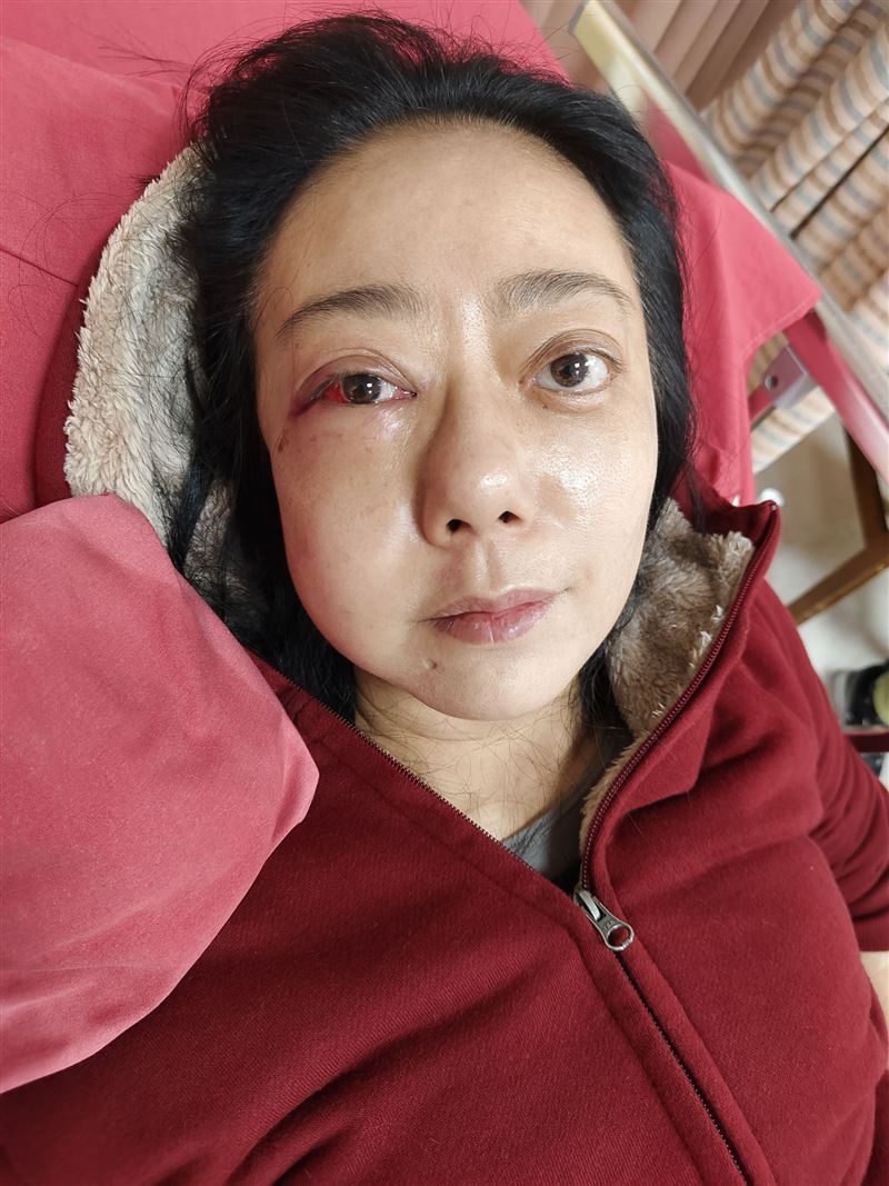 高慧君臉部嚴重腫脹。（圖／經紀人提供）