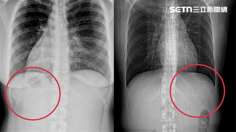 二寶媽是先天性臟器逆位患者，全身臟器位置與常人相反，發生率僅萬分之一，手術困難度極高。（圖／翻攝畫面）