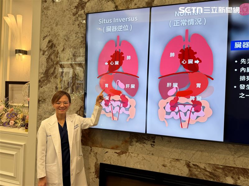 劉家嘉醫師表示，二寶媽是先天性臟器逆位患者，全身臟器位置與常人相反，發生率僅萬分之一，手術困難度極高。（圖／翻攝畫面）