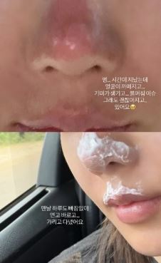 權恩妃分享多張傷勢照。（圖／翻攝自IG）