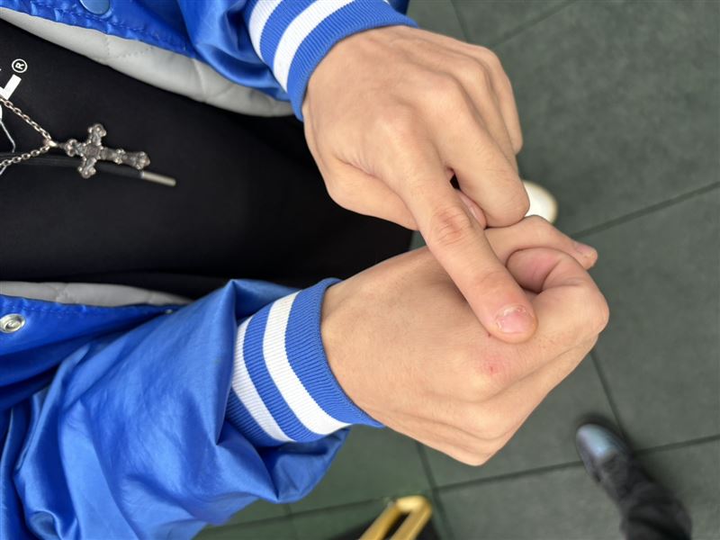 FAMA手部擦傷，外套也有多處破損。（圖／迷音樂提供）