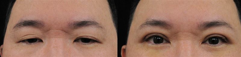 林男因眼瞼下垂，長期視線受限、自信下降，生活與社交受影響，接受「提眼瞼肌」矯正手術後，眼神明亮，心理與日常生活明顯改善。（圖／衛福部彰化醫院提供）