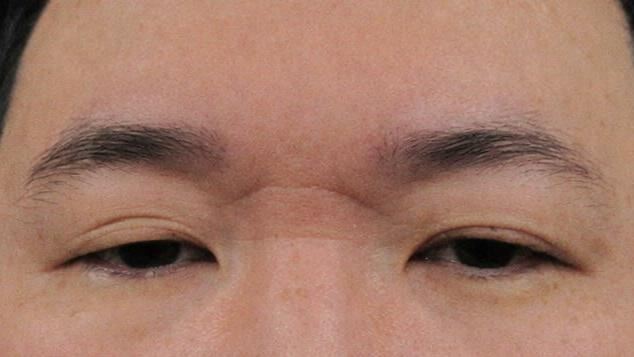 30歲男眼小撐不開！常躲媽背後 醫揭4隱患