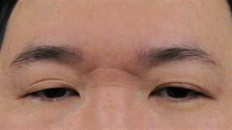 30歲男眼小撐不開！常躲媽背後 醫揭4隱患