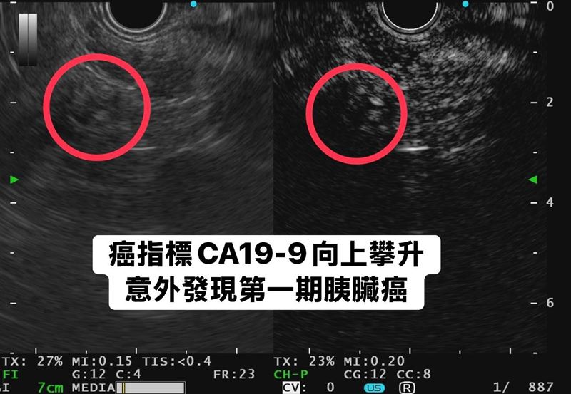 個案接受胰臟內視鏡超音波檢查，發現一顆約1公分腫瘤。（圖／翻攝自林相宏臉書）