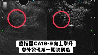 沒有不舒服　她靠「1指標」揪出胰臟癌