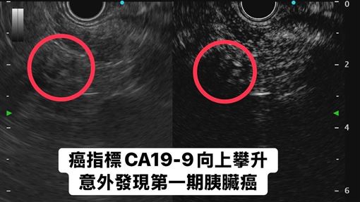 沒有不舒服　她靠「1指標」揪出胰臟癌