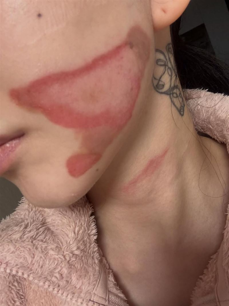 AOA前成員珉娥發生嚴重醫療事故，臉部出現「深層二度燒傷」。（圖／翻攝自IG @new.kma）