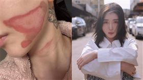 AOA前成員珉娥發生嚴重醫療事故，臉部出現「深層二度燒傷」。（圖／翻攝自IG @new.kma）