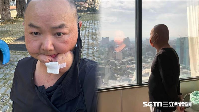 獨／被笑狂犬病　戴口罩廚：我只是口腔癌