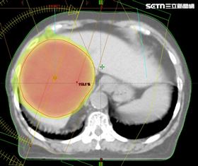 腫瘤指數破千！84歲嬤免挨刀穩控膽管癌(圖／翻攝畫面）