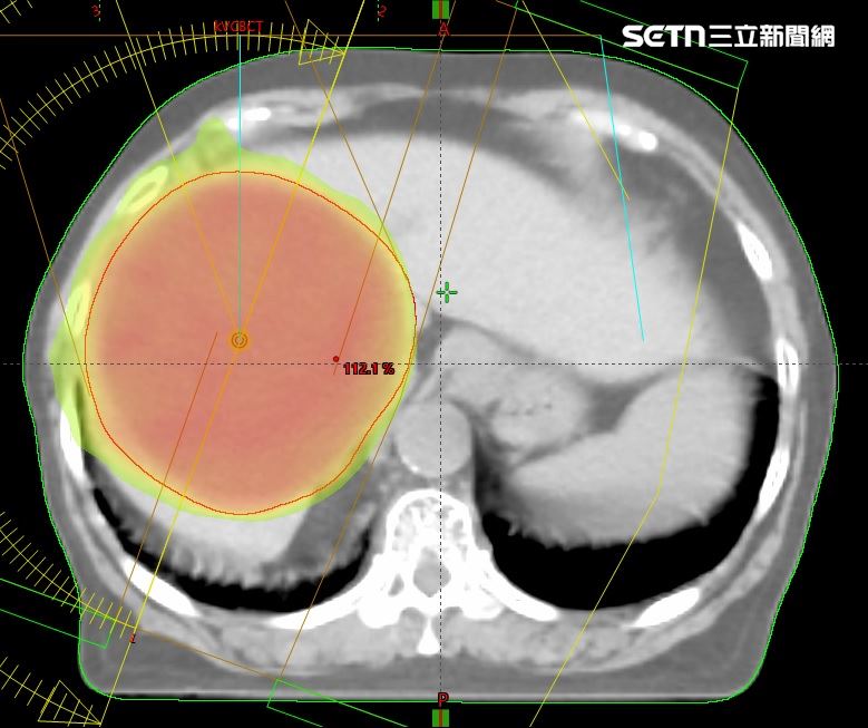 腫瘤指數破千！84歲嬤免挨刀穩控膽管癌
