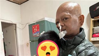 三寶爸癌復發「切大片右臉」幼子撫臉秀秀