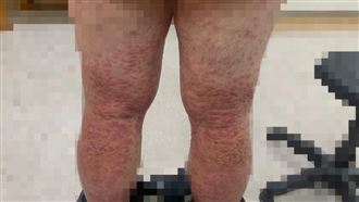 胃痛又潰瘍⋯一檢查竟罹梅毒！台中男認了