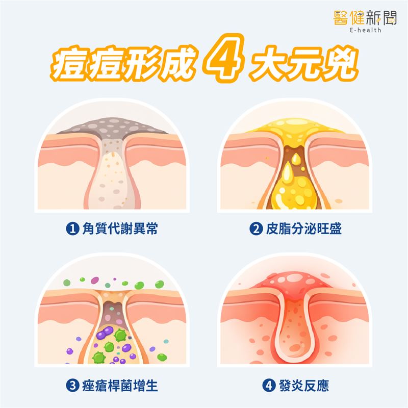 痘痘反覆長？別只顧著殺菌！痘痘形成4大原因，醫揭「皮脂腺」過勞了！（圖／醫健新聞網提供）