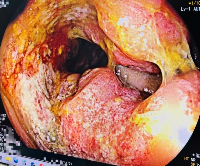 一名中年男子長達半年血便未予理會，直到排便不順才就醫，被診斷出直腸腫瘤，且已造成腸道阻塞。（圖／陳英傑醫師授權提供）