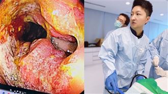 血便誤認痔瘡！得知直腸癌　他豁達逼哭醫