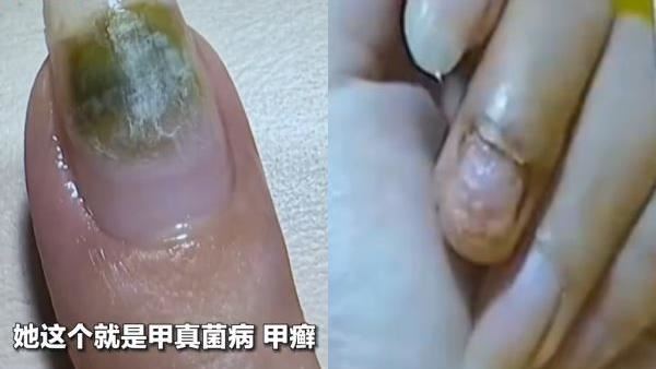 美甲集體感染 HPV　醫：噴酒精根本防不住