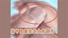 ▲網傳指甲甲面出現「豎紋」是大病癥兆，專家醫師否認這樣的說法。（圖／翻攝自事實查核中心官網）