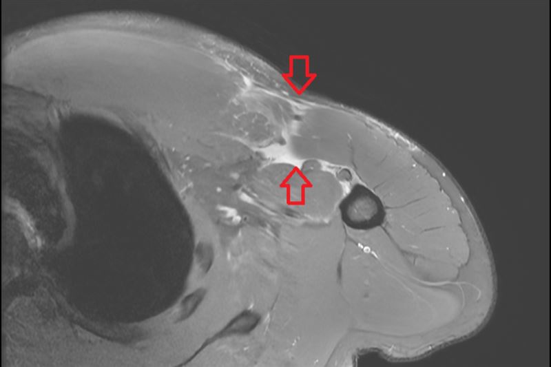 個案核磁共振檢查發現其右側胸大肌斷裂。（圖．台北慈濟醫院提供）