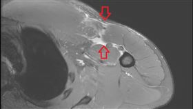 個案核磁共振檢查發現其右側胸大肌斷裂。（圖．台北慈濟醫院提供）