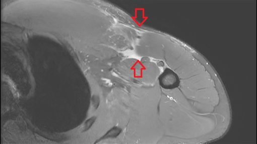 他健身突胸痛腫脹　竟罕見「胸大肌斷裂」