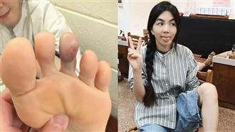Ella曬腳趾發紫照　挨針滲血畫面全曝光