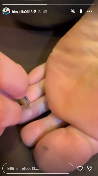 Ella腳趾發紫去診所挨針治療。（圖／翻攝自IG @him_ella0618）