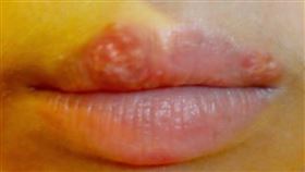 復發性唇疱疹是由具有傳染性的單純疱疹病毒一型病毒所引起。圖為示意圖，非新聞當事人。（圖／翻攝自維基百科）
