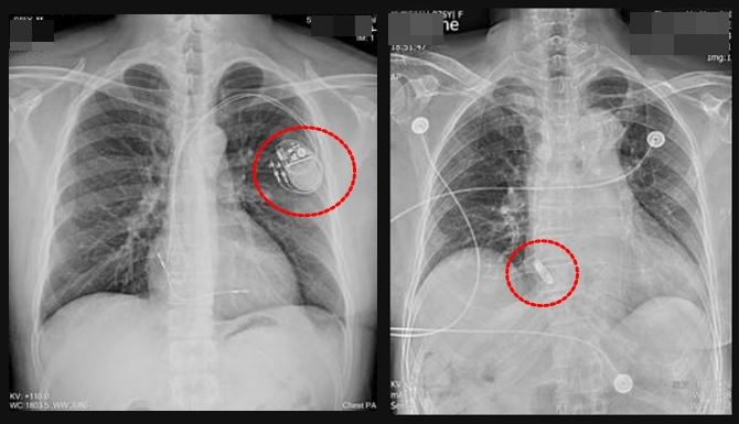 圖左為傳統心臟節律器，圖右為無導線心臟節律器，體積小如膠囊，可直接植入心腔 。（圖／雙和醫院提供）