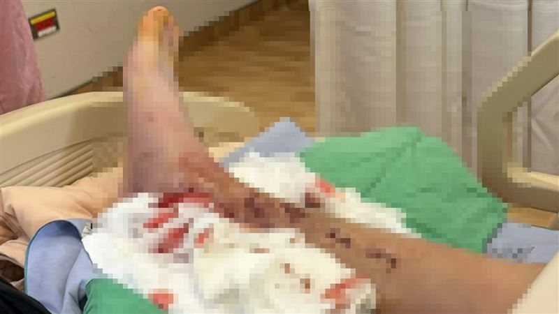 公車疑擦撞機車致騎士骨折 司機疑肇逃