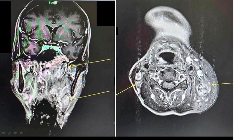 病人透過核磁共振檢查，確診為鼻咽癌(黃色箭頭處)。（圖／大千綜合醫院提供）