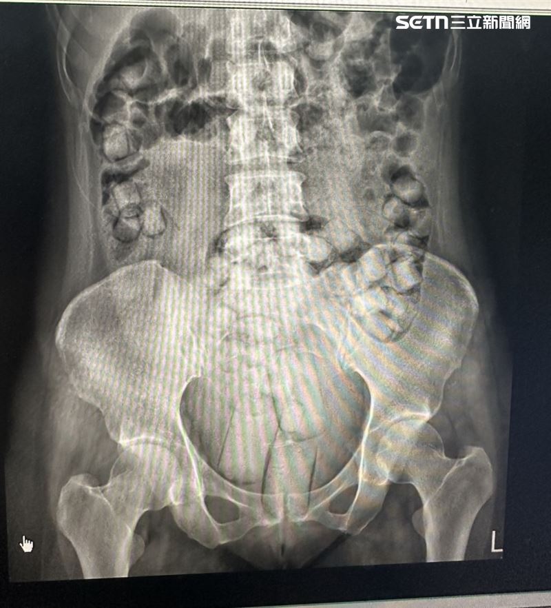 2泰女「人體運毒」，肛塞、吞食115顆海洛因球闖關，一入境就被抓。（圖／資料照）