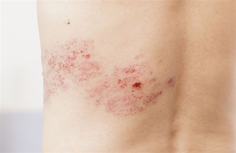 台灣帶狀疱疹「皮蛇」發生率持續攀升，每年約有12萬人新發罹患帶狀疱疹。（圖／台灣家庭醫學醫學會提供）