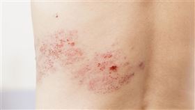 皮蛇,帶狀疱疹。（圖／台灣家庭醫學醫學會提供）