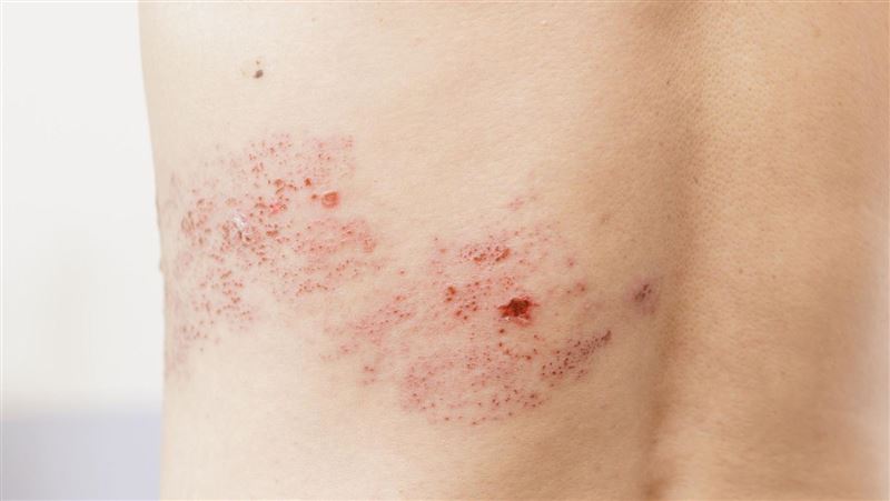 皮蛇年增12萬人新發病　醫：恐增心梗風險