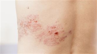 皮蛇年增12萬人新發病　醫：恐增心梗風險