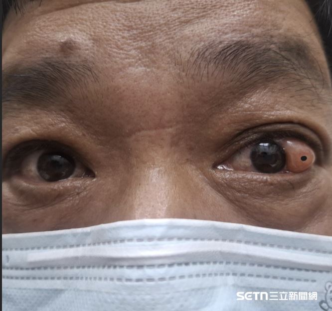 郭先生左眼外側於4年前突然長出一顆黃白色腫塊，上頭還有個黑點，宛如「第三隻眼」，已影響其視線及社交。（圖／洪啟庭提供）